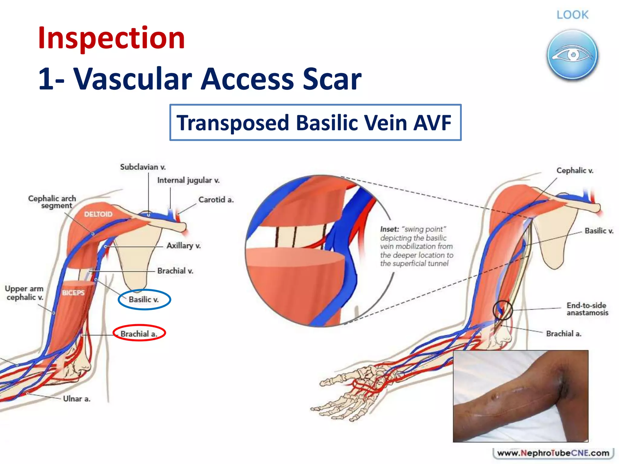 Resection Avf How to examine AVF in 10 minutes - Dr. Gawad | PPTX