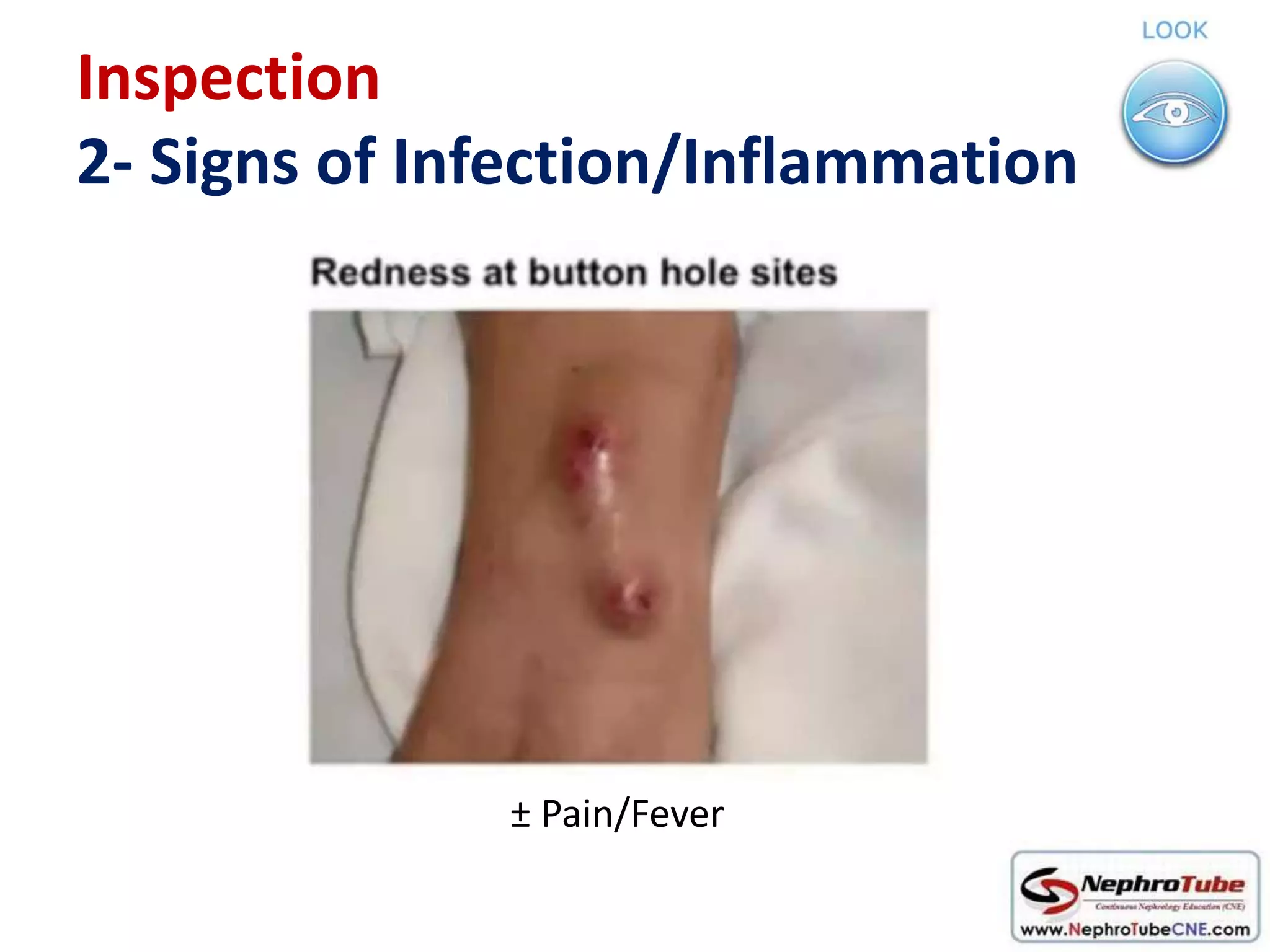 Avf Infection How to examine AVF in 10 minutes - Dr. Gawad | PPTX