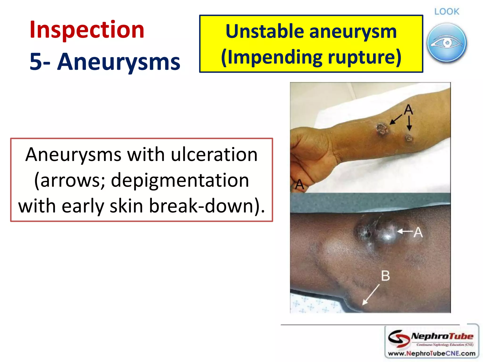 Avf Rupture How to examine AVF in 10 minutes - Dr. Gawad | PPTX