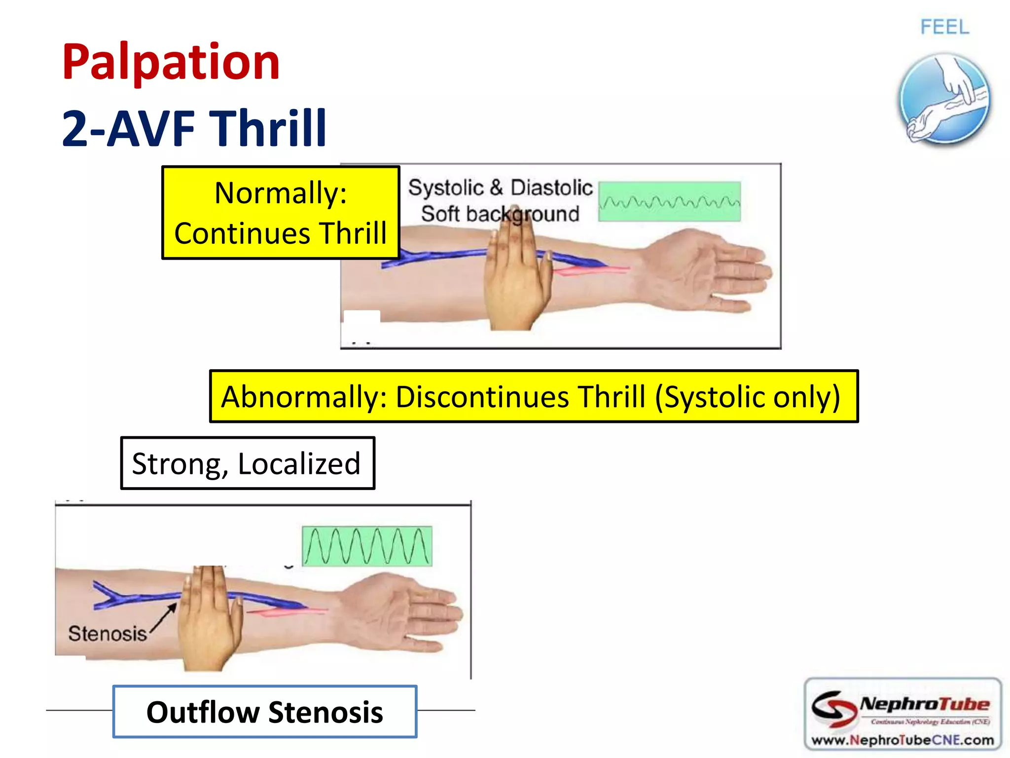 How to examine AVF in 10 minutes - Dr. Gawad | PPTX