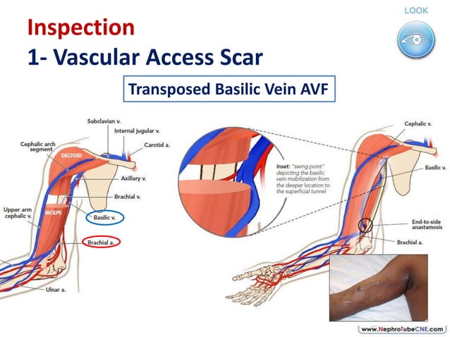 How to examine AVF in 10 minutes - Dr. Gawad | PPTX | Blood Disorders ...