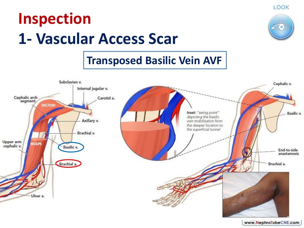 How to examine AVF in 10 minutes Dr. Gawad