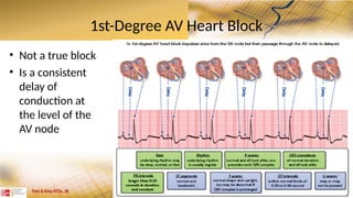 Atrioventricular Heart Blocks causes.ppt