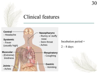 Clinical features
Incubation period =
2 – 8 days
30
 