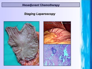 Neoadjuvant Chemotherapy Staging Laparoscopy 