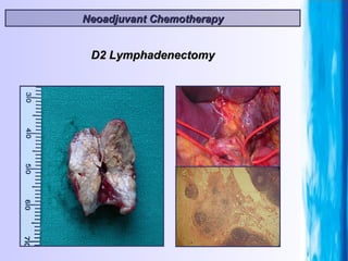 Neoadjuvant Chemotherapy D2 Lymphadenectomy 