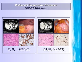 T 3  N 2   antrum Multimodal Preoperative Treatment: FOX-RT Trial and… pT 2 N 1   (N+ 1/21) 