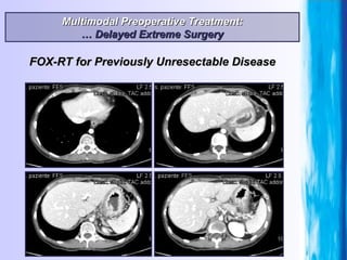 Multimodal Preoperative Treatment: …  Delayed Extreme Surgery FOX-RT for Previously Unresectable Disease 