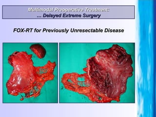 Multimodal Preoperative Treatment: …  Delayed Extreme Surgery FOX-RT for Previously Unresectable Disease 