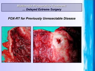 Multimodal Preoperative Treatment: …  Delayed Extreme Surgery FOX-RT for Previously Unresectable Disease 