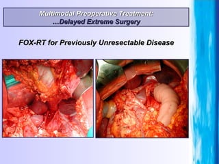 Multimodal Preoperative Treatment: … Delayed Extreme Surgery FOX-RT for Previously Unresectable Disease 