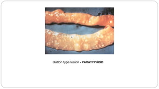 Button type lesion - PARATYPHOID
 