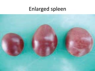 Enlarged spleen
 