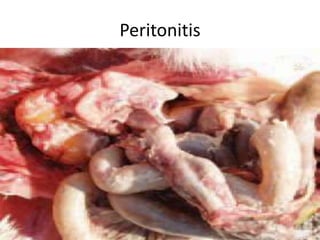 Peritonitis
 