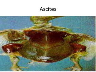 Ascites
 