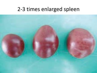 2-3 times enlarged spleen
 