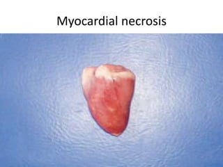 Myocardial necrosis
 