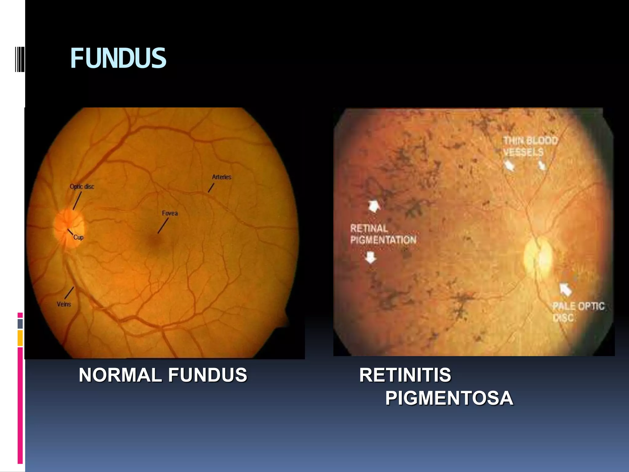case presentation on retinitis pigmentosa (low vision aid) PPT