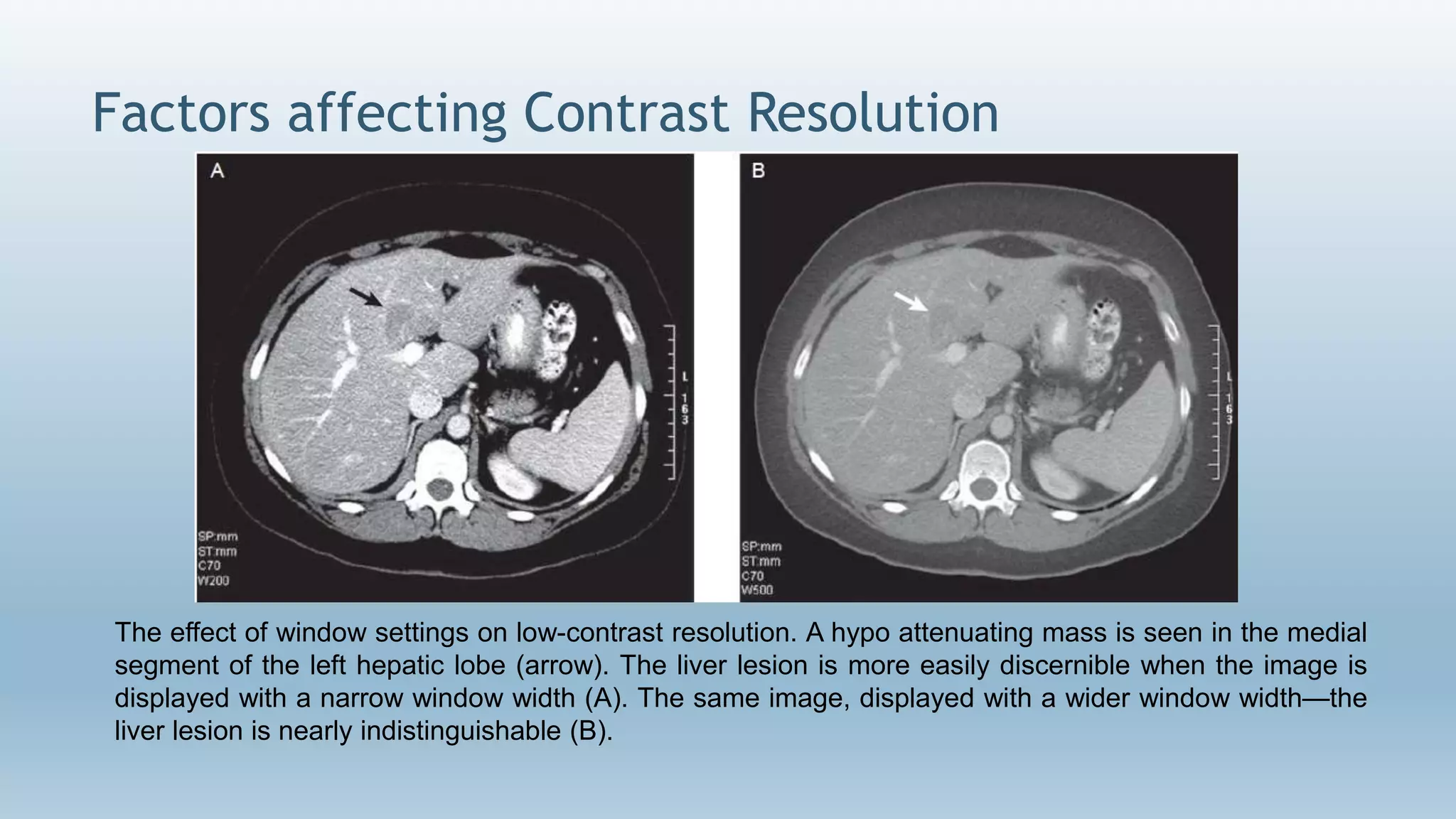 Factors affecting Contrast Resolution
The effect of window settings on low-contrast resolution. A hypo attenuating mass is seen in the medial
segment of the left hepatic lobe (arrow). The liver lesion is more easily discernible when the image is
displayed with a narrow window width (A). The same image, displayed with a wider window width—the
liver lesion is nearly indistinguishable (B).
 