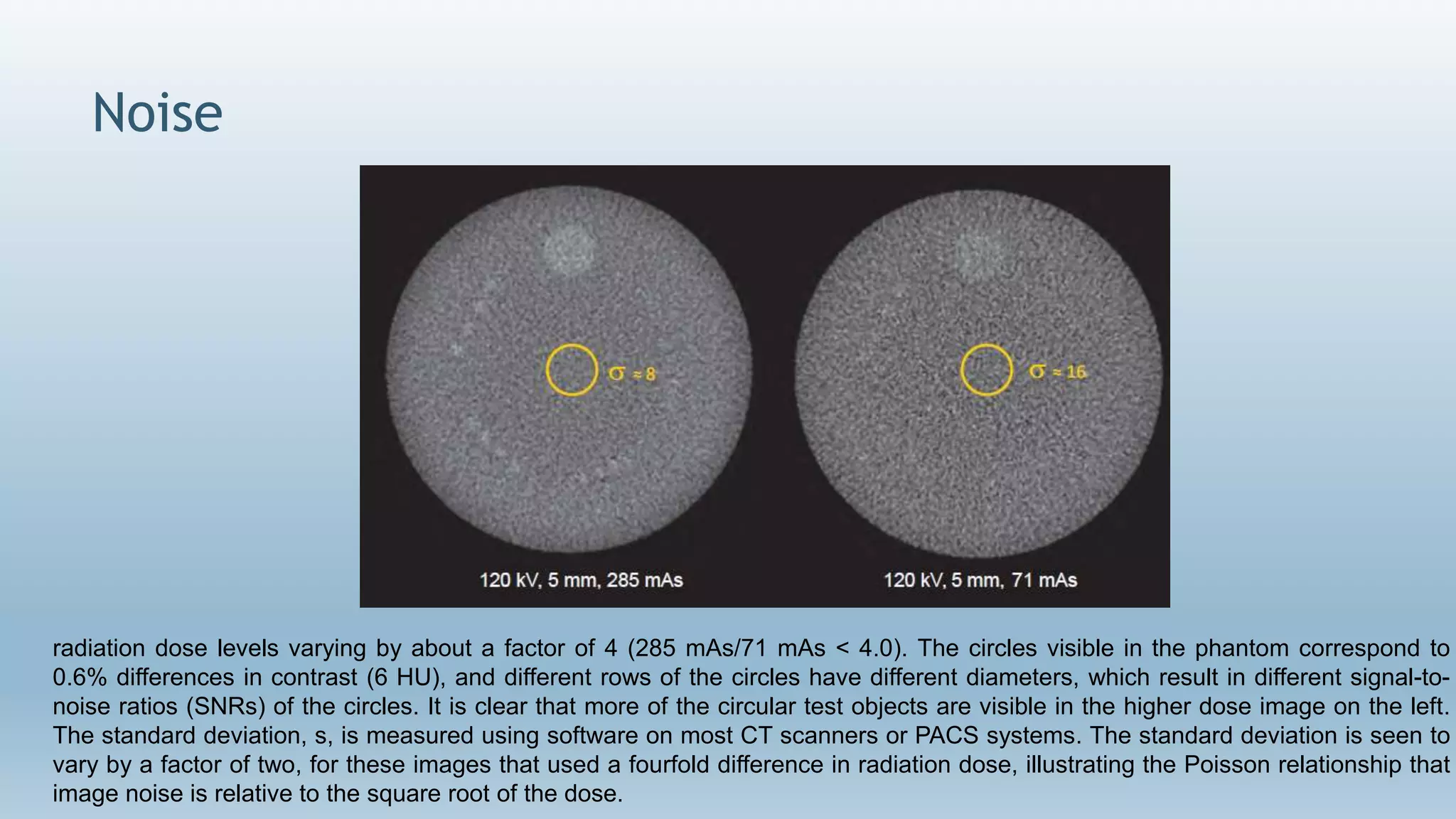 Noise
radiation dose levels varying by about a factor of 4 (285 mAs/71 mAs < 4.0). The circles visible in the phantom correspond to
0.6% differences in contrast (6 HU), and different rows of the circles have different diameters, which result in different signal-to-
noise ratios (SNRs) of the circles. It is clear that more of the circular test objects are visible in the higher dose image on the left.
The standard deviation, s, is measured using software on most CT scanners or PACS systems. The standard deviation is seen to
vary by a factor of two, for these images that used a fourfold difference in radiation dose, illustrating the Poisson relationship that
image noise is relative to the square root of the dose.
 