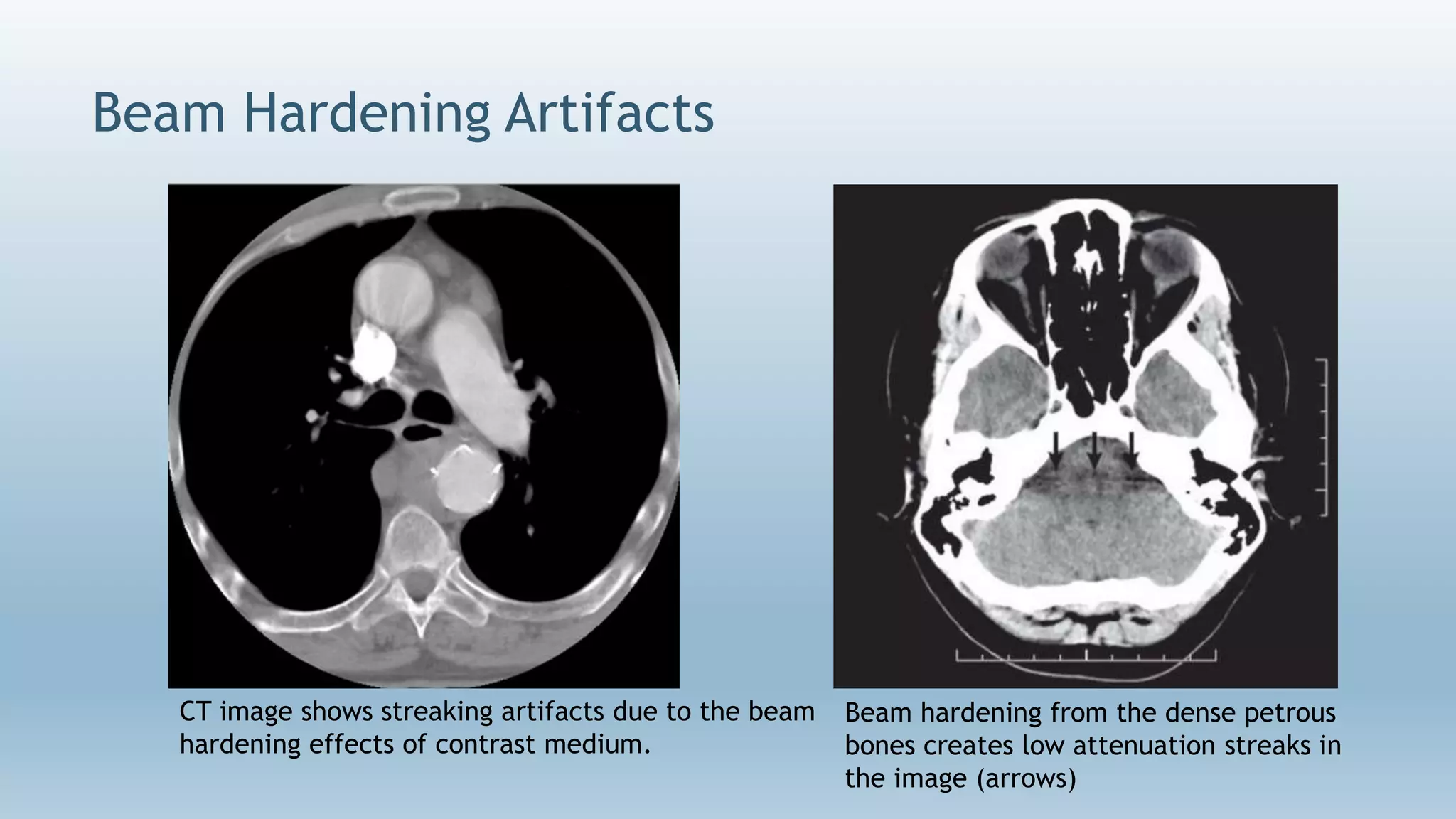Beam Hardening Artifacts
CT image shows streaking artifacts due to the beam
hardening effects of contrast medium.
Beam hardening from the dense petrous
bones creates low attenuation streaks in
the image (arrows)
 
