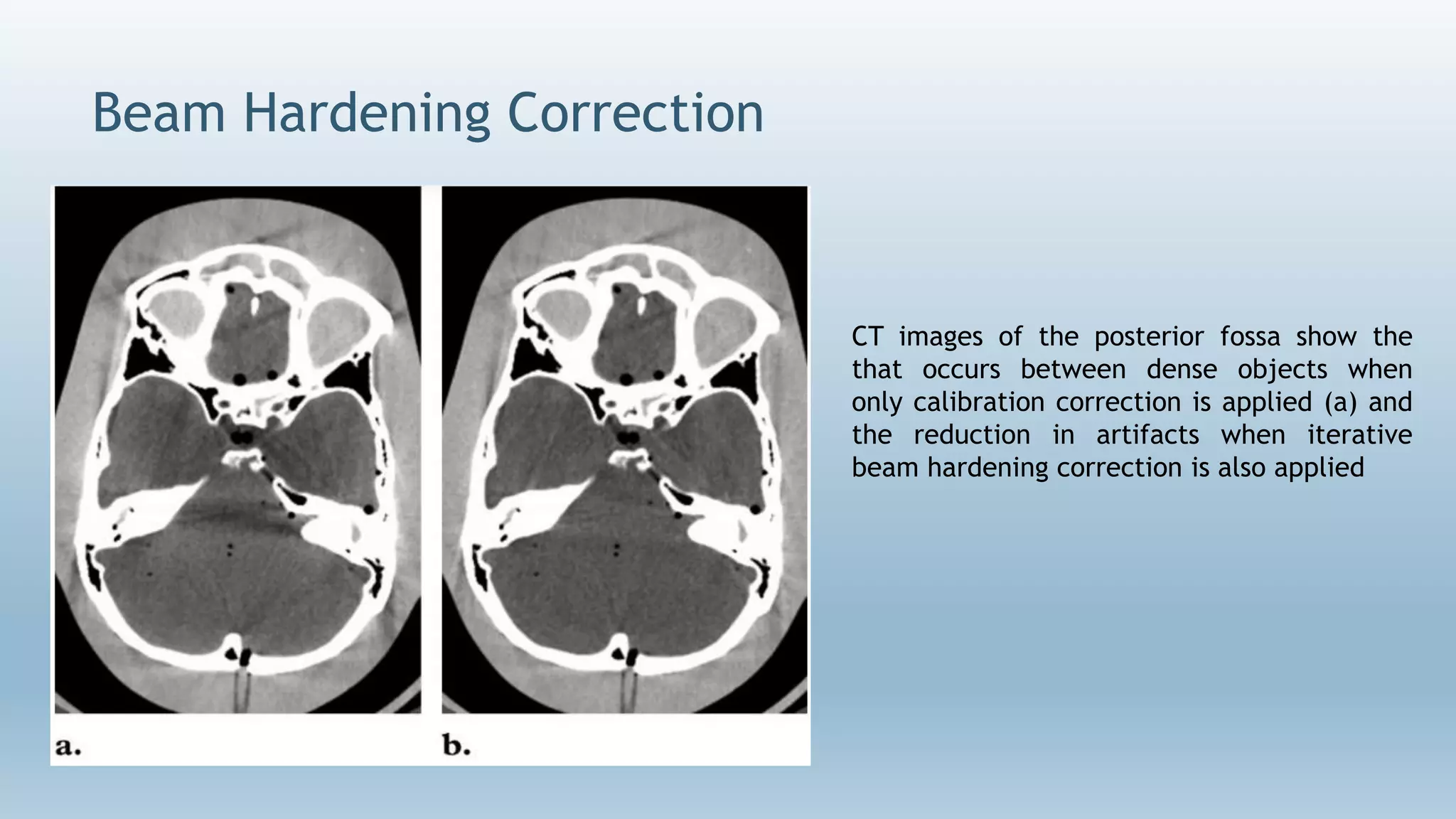 Beam Hardening Correction
 dark banding
CT images of the posterior fossa show the
that occurs between dense objects when
only calibration correction is applied (a) and
the reduction in artifacts when iterative
beam hardening correction is also applied
 