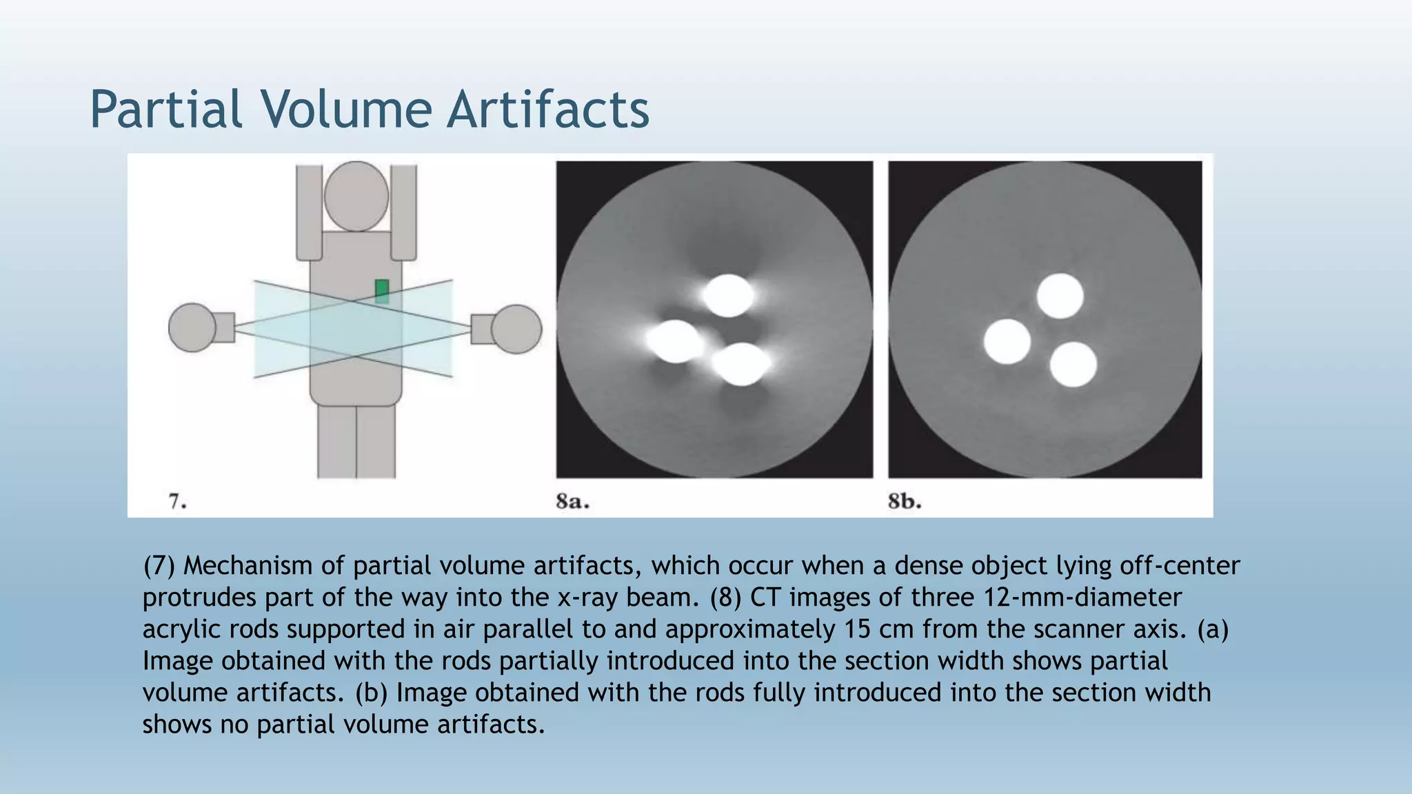 Partial Volume Artifacts
(7) Mechanism of partial volume artifacts, which occur when a dense object lying off-center
protrudes part of the way into the x-ray beam. (8) CT images of three 12-mm-diameter
acrylic rods supported in air parallel to and approximately 15 cm from the scanner axis. (a)
Image obtained with the rods partially introduced into the section width shows partial
volume artifacts. (b) Image obtained with the rods fully introduced into the section width
shows no partial volume artifacts.
 