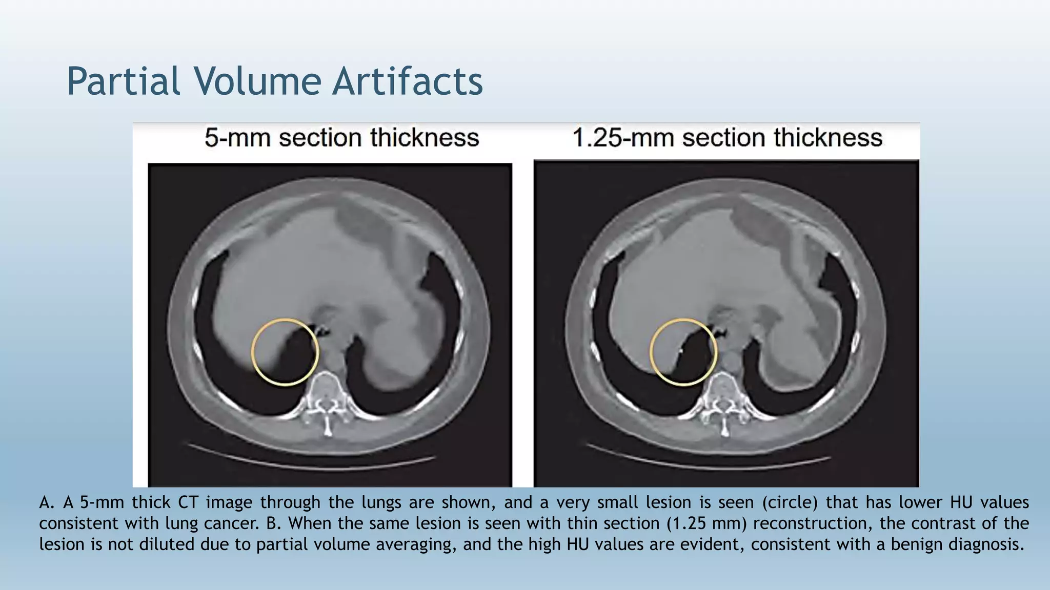 Partial Volume Artifacts
A. A 5-mm thick CT image through the lungs are shown, and a very small lesion is seen (circle) that has lower HU values
consistent with lung cancer. B. When the same lesion is seen with thin section (1.25 mm) reconstruction, the contrast of the
lesion is not diluted due to partial volume averaging, and the high HU values are evident, consistent with a benign diagnosis.
 