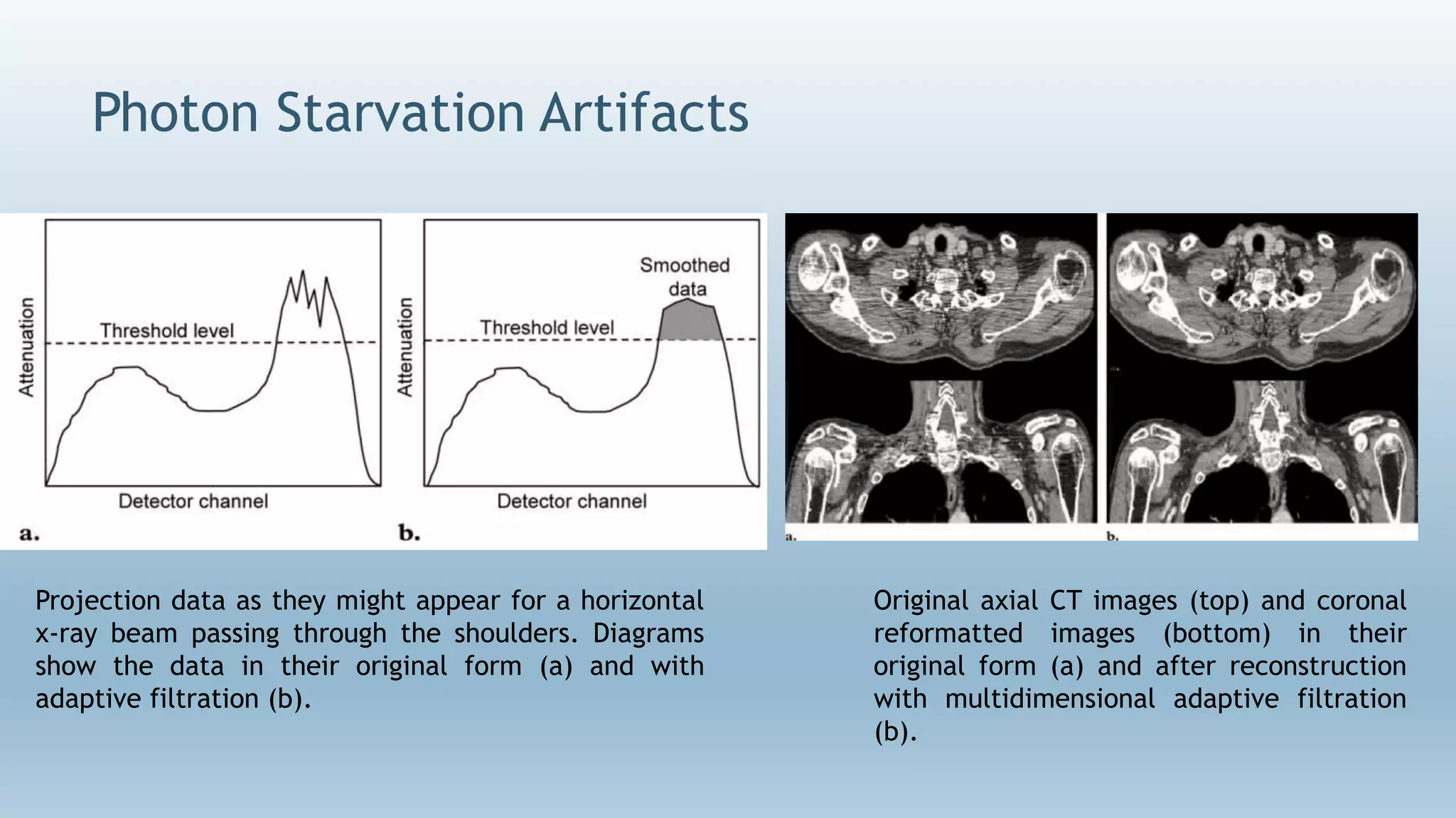 Photon Starvation Artifacts
Projection data as they might appear for a horizontal
x-ray beam passing through the shoulders. Diagrams
show the data in their original form (a) and with
adaptive filtration (b).
Original axial CT images (top) and coronal
reformatted images (bottom) in their
original form (a) and after reconstruction
with multidimensional adaptive filtration
(b).
 