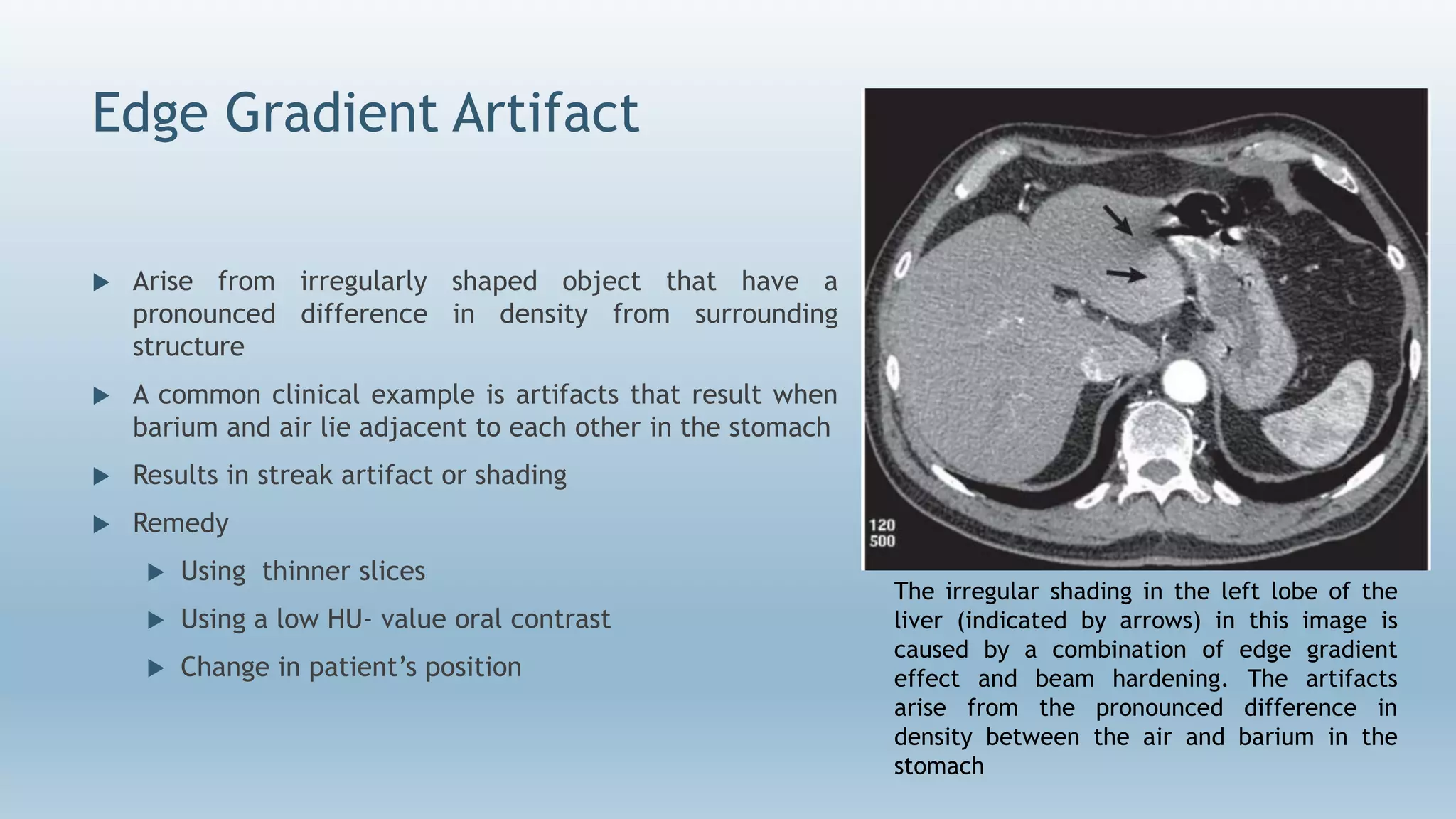 Edge Gradient Artifact
 Arise from irregularly shaped object that have a
pronounced difference in density from surrounding
structure
 A common clinical example is artifacts that result when
barium and air lie adjacent to each other in the stomach
 Results in streak artifact or shading
 Remedy
 Using thinner slices
 Using a low HU- value oral contrast
 Change in patient’s position
The irregular shading in the left lobe of the
liver (indicated by arrows) in this image is
caused by a combination of edge gradient
effect and beam hardening. The artifacts
arise from the pronounced difference in
density between the air and barium in the
stomach
 