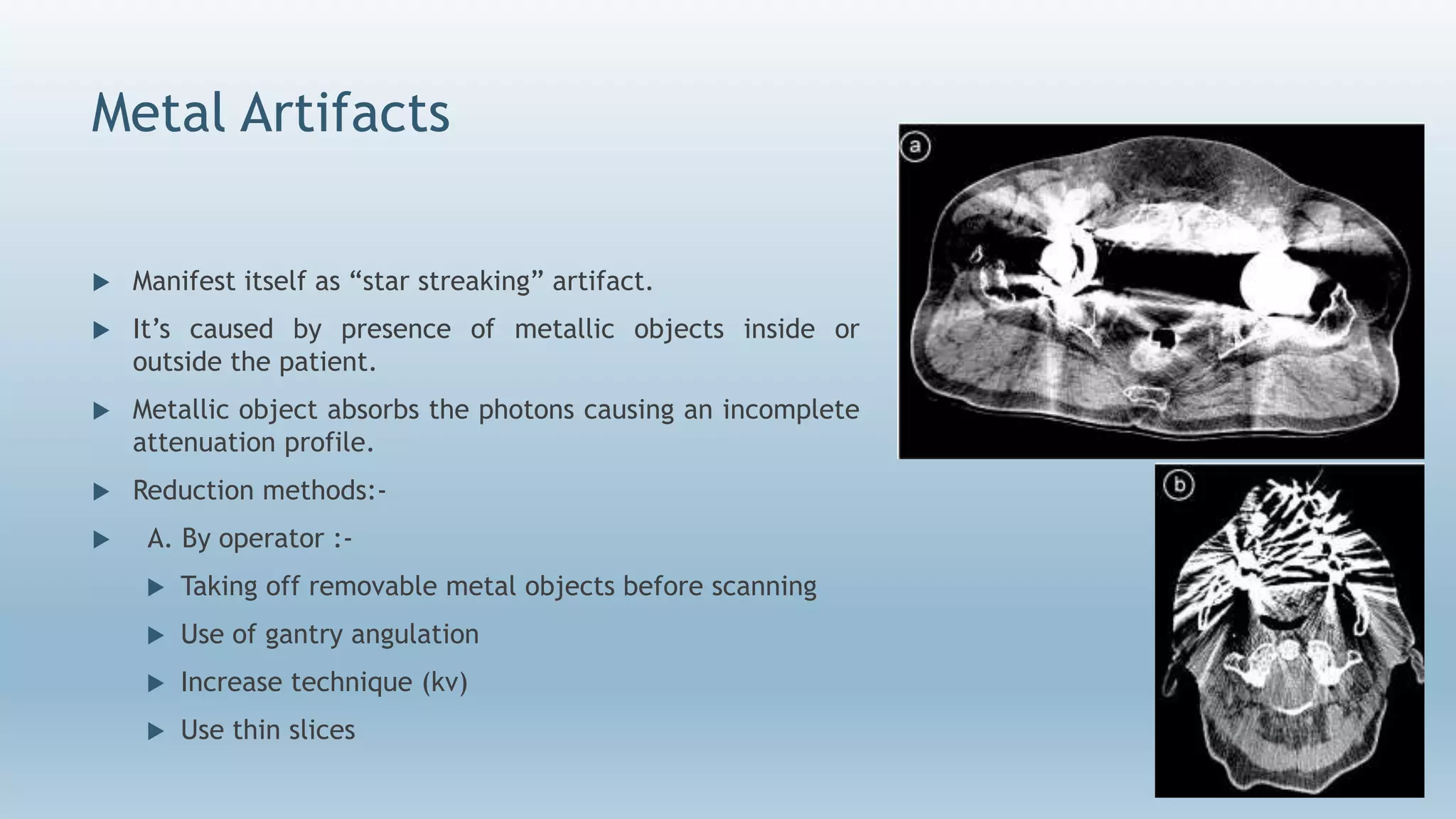 Metal Artifacts
 Manifest itself as “star streaking” artifact.
 It’s caused by presence of metallic objects inside or
outside the patient.
 Metallic object absorbs the photons causing an incomplete
attenuation profile.
 Reduction methods:-
 A. By operator :-
 Taking off removable metal objects before scanning
 Use of gantry angulation
 Increase technique (kv)
 Use thin slices
 