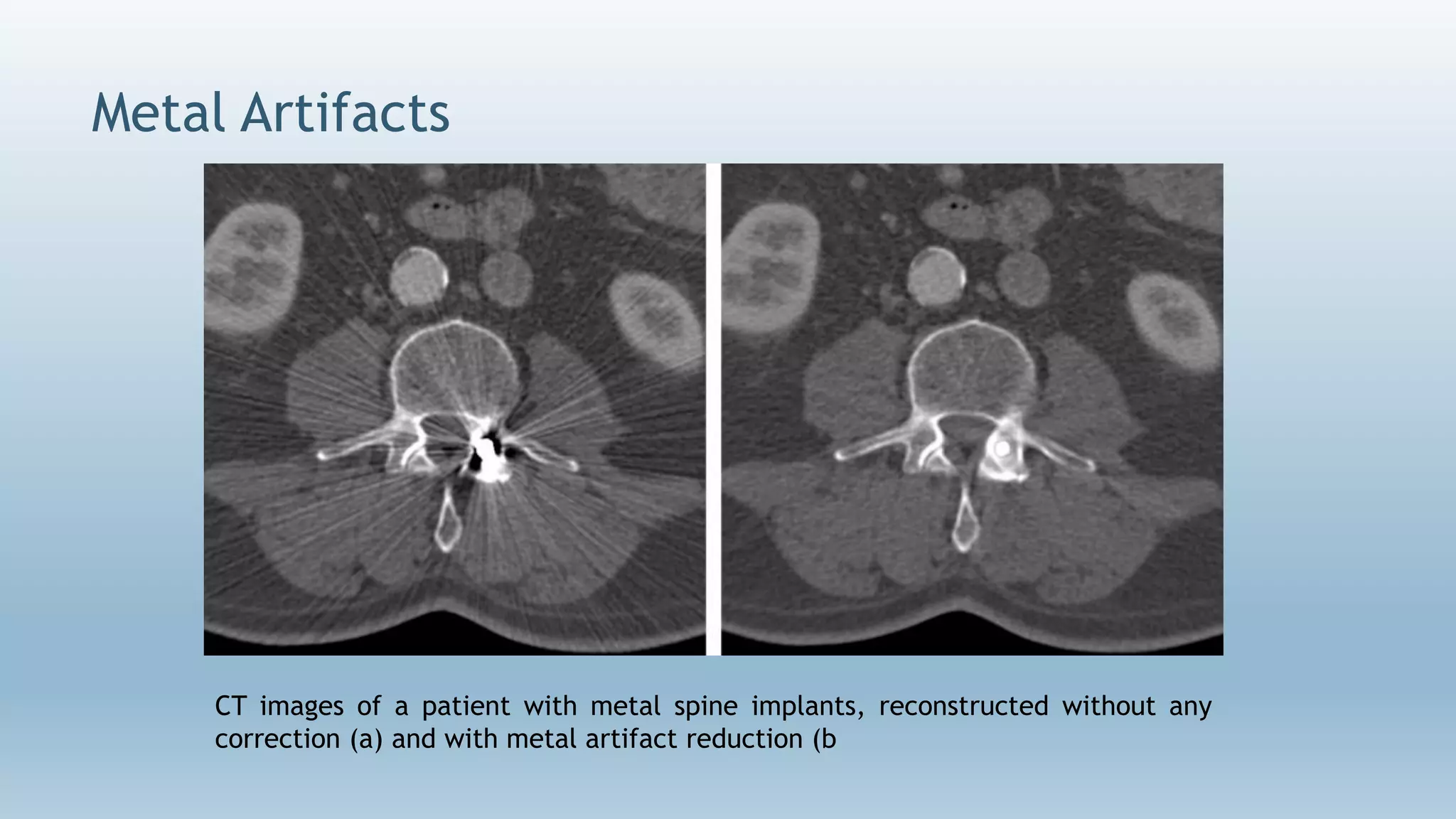 Metal Artifacts
CT images of a patient with metal spine implants, reconstructed without any
correction (a) and with metal artifact reduction (b
 