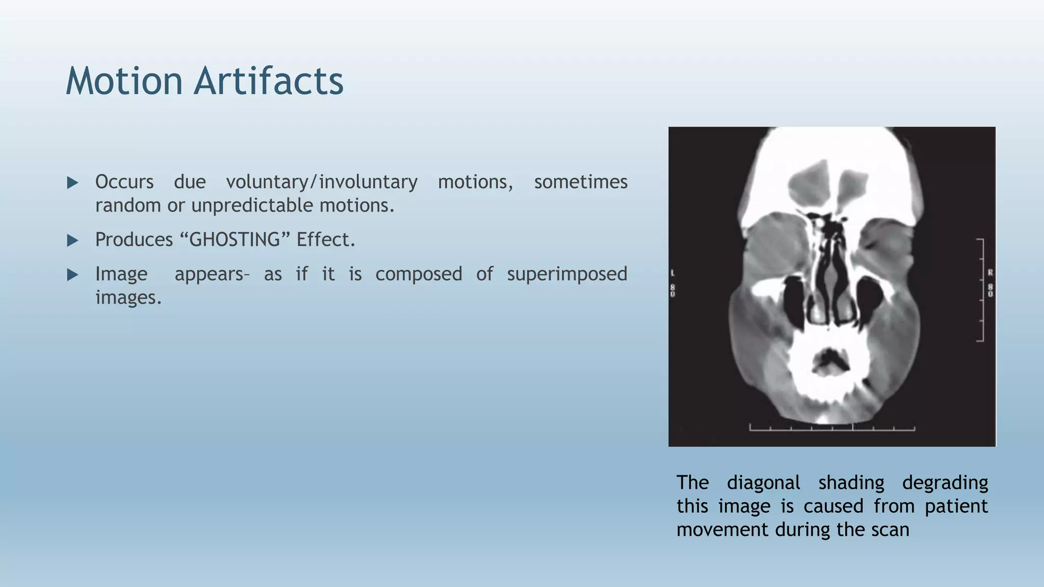 Motion Artifacts
 Occurs due voluntary/involuntary motions, sometimes
random or unpredictable motions.
 Produces “GHOSTING” Effect.
 Image appears– as if it is composed of superimposed
images.
The diagonal shading degrading
this image is caused from patient
movement during the scan
 