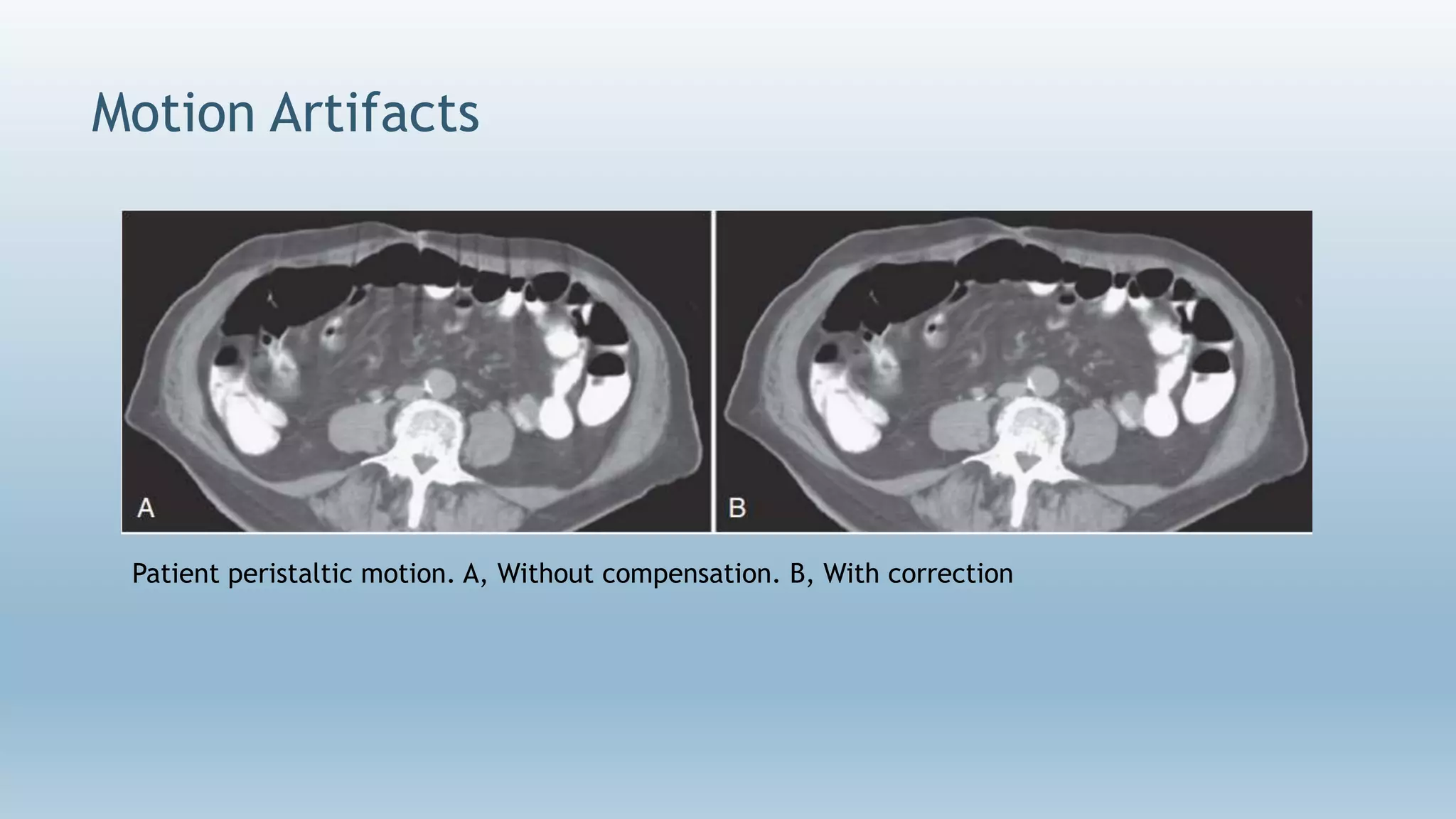 Motion Artifacts
Patient peristaltic motion. A, Without compensation. B, With correction
 