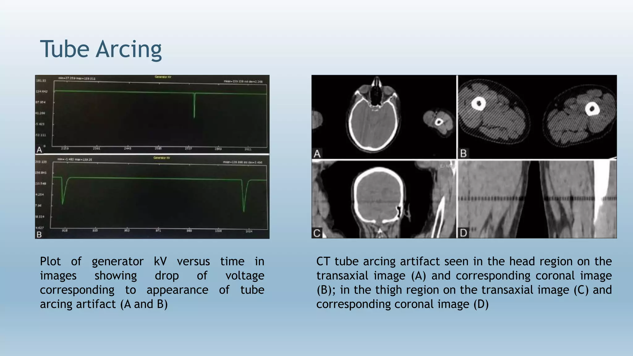 Tube Arcing
CT tube arcing artifact seen in the head region on the
transaxial image (A) and corresponding coronal image
(B); in the thigh region on the transaxial image (C) and
corresponding coronal image (D)
Plot of generator kV versus time in
images showing drop of voltage
corresponding to appearance of tube
arcing artifact (A and B)
 