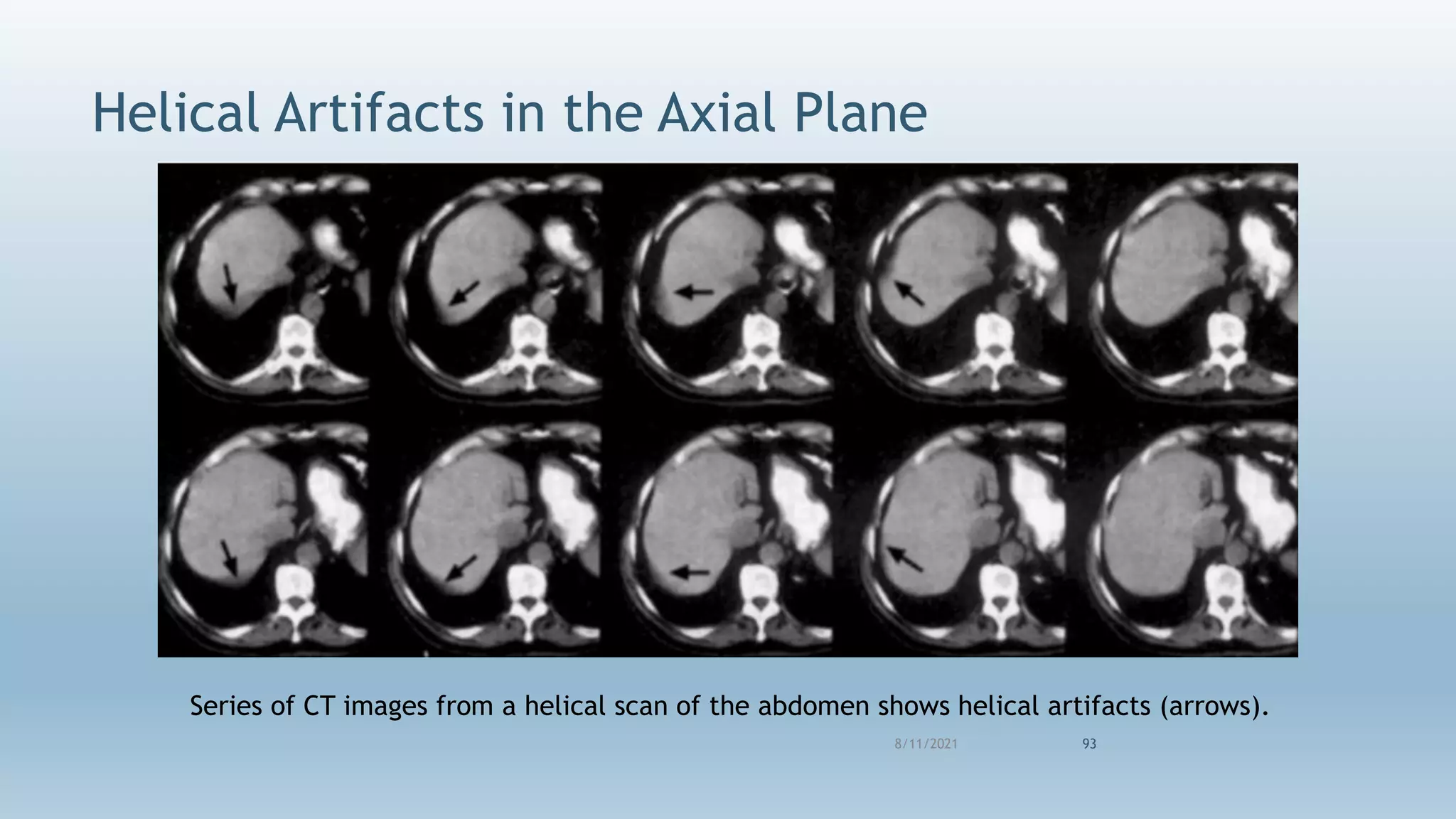 Helical Artifacts in the Axial Plane
8/11/2021 93
Series of CT images from a helical scan of the abdomen shows helical artifacts (arrows).
 