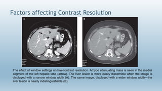 Image Quality, Artifacts and it's Remedies in CT-Avinesh Shrestha | PPTX