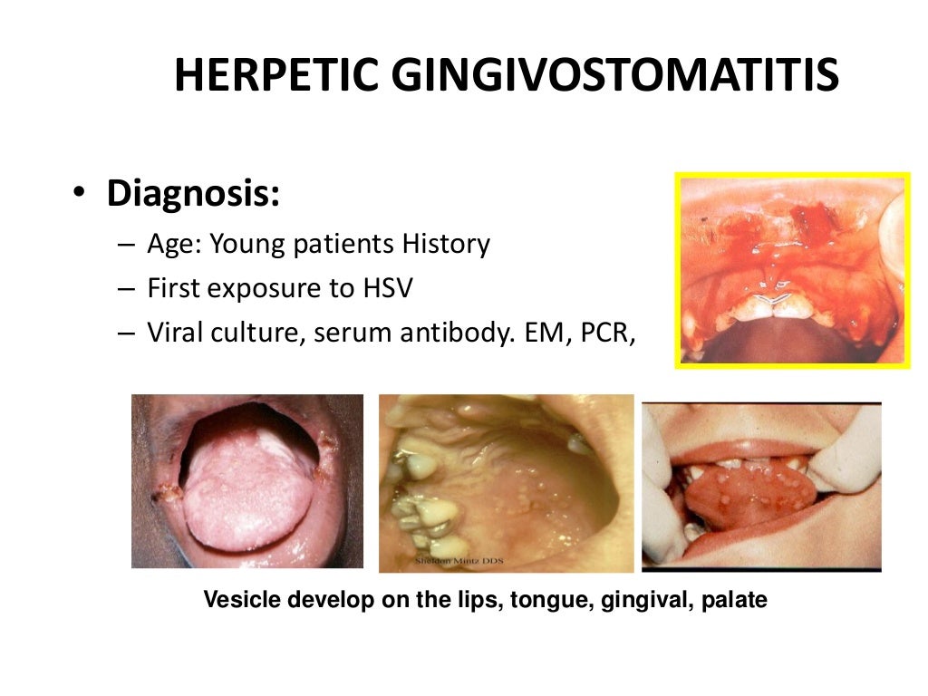 A viral infections of mouth