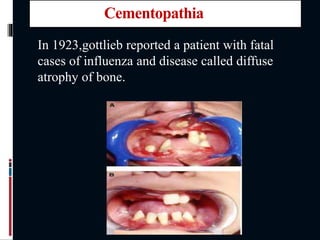 Cementopathia
In 1923,gottlieb reported a patient with fatal
cases of influenza and disease called diffuse
atrophy of bone.
 