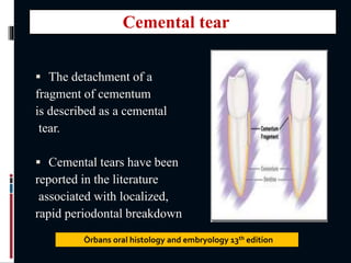  The detachment of a
fragment of cementum
is described as a cemental
tear.
 Cemental tears have been
reported in the literature
associated with localized,
rapid periodontal breakdown
Òrbans oral histology and embryology 13th edition
Cemental tear
 