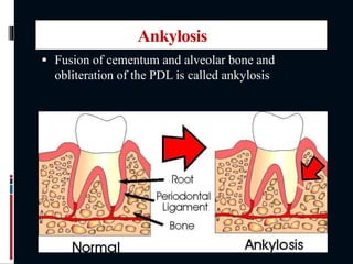 Ankylosis
 Fusion of cementum and alveolar bone and
obliteration of the PDL is called ankylosis
 