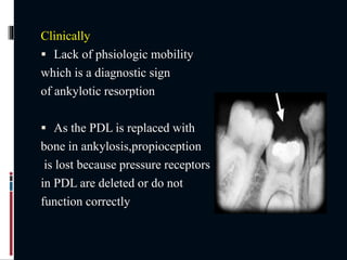Clinically
 Lack of phsiologic mobility
which is a diagnostic sign
of ankylotic resorption
 As the PDL is replaced with
bone in ankylosis,propioception
is lost because pressure receptors
in PDL are deleted or do not
function correctly
 