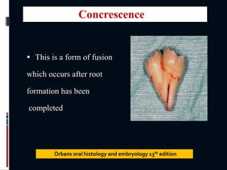 This is a form of fusion
which occurs after root
formation has been
completed
Òrbans oral histology and embryology 13th edition
Concrescence
 