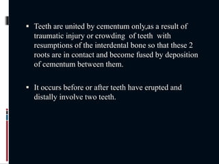  Teeth are united by cementum only,as a result of
traumatic injury or crowding of teeth with
resumptions of the interdental bone so that these 2
roots are in contact and become fused by deposition
of cementum between them.
 It occurs before or after teeth have erupted and
distally involve two teeth.
 