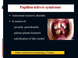 Papillon-lefevre syndrome
 Autosomal recessive disorder
 It consist of:
juvenile periodontitis
palmar plantar keratotis
calcification of falx cerebri
Shafers textbook of oral pathology 7th edition
 