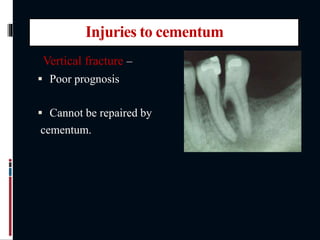 Injuries to cementum
Vertical fracture –
 Poor prognosis
 Cannot be repaired by
cementum.
 