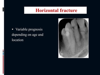  Variable prognosis
depending on age and
location
Horizontal fracture
 