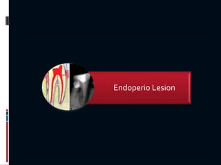 Endoperio Lesion
 