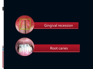 Root caries
Gingival recession
 