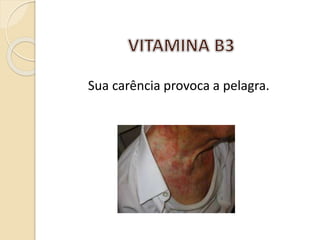 Sua carência provoca a pelagra.
 